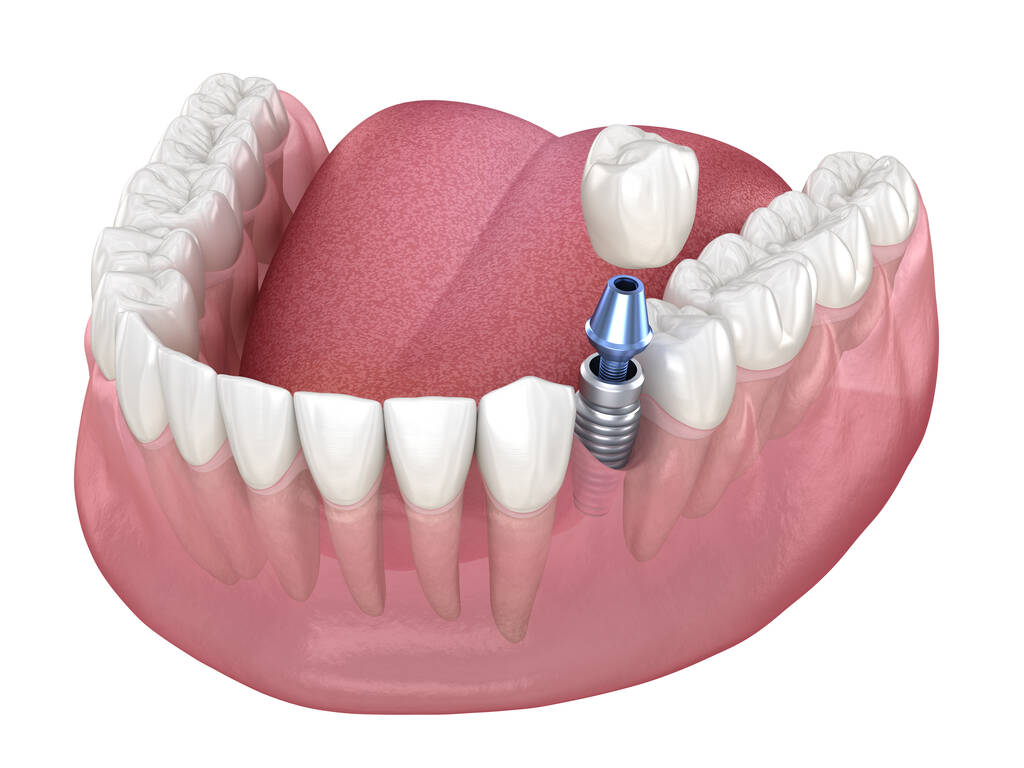 Affordable dental implants in Perth