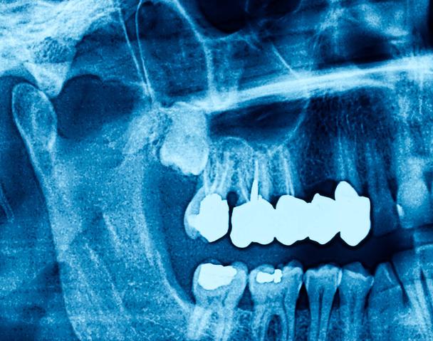Wisdom Tooth Removal Joondalup Average Cost Of Wisdom Tooth Removal Joondalup