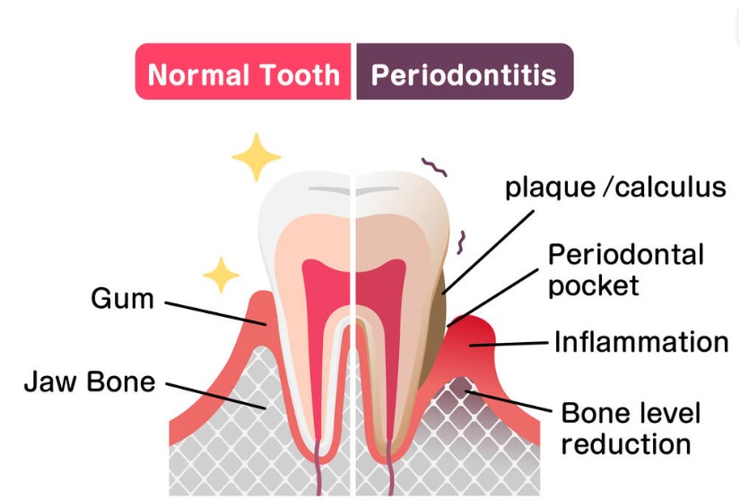 gum disease